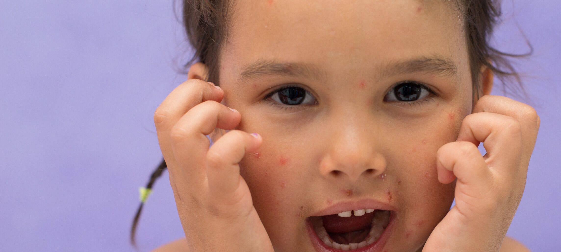 Kaum Windpocken-Infektionen in Dortmund