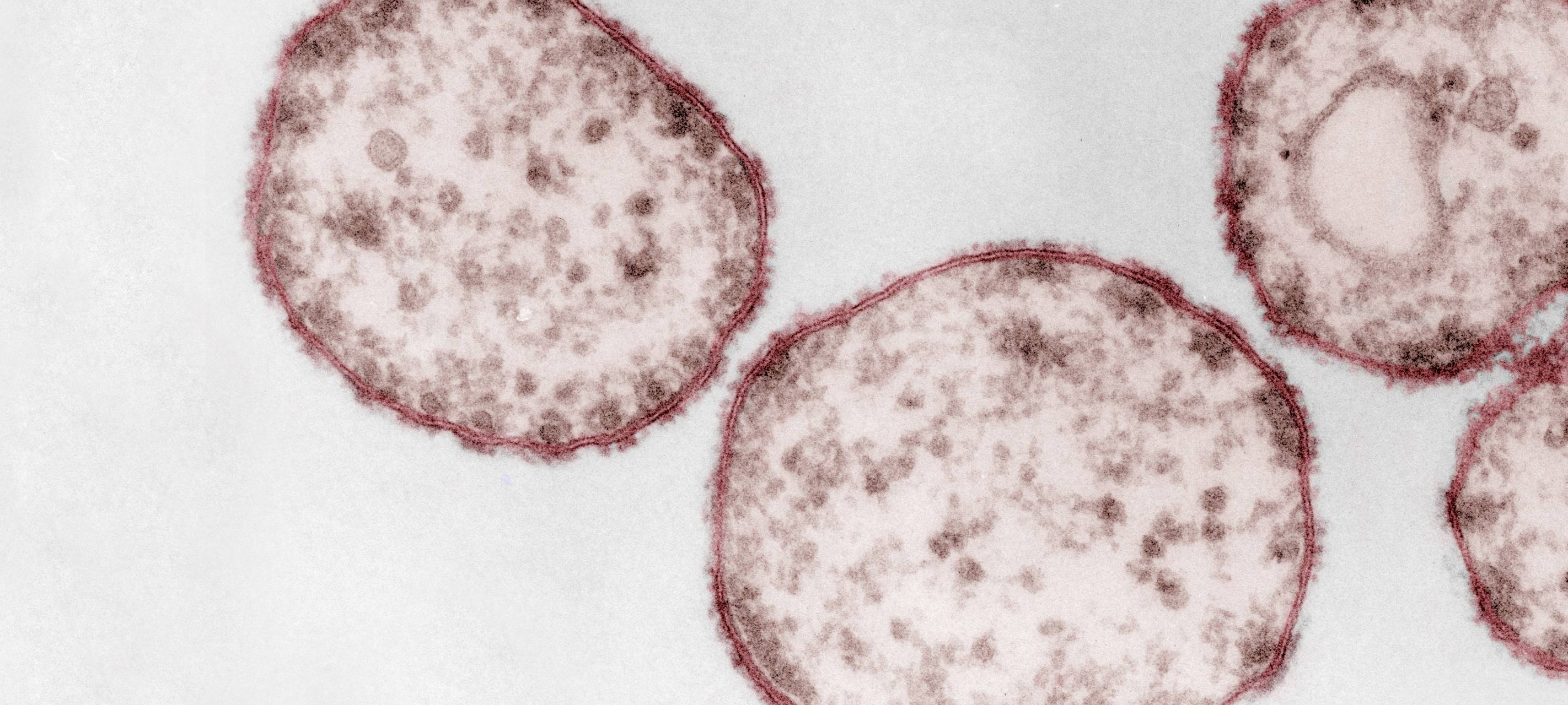 Kolorierte Aufnahme des Masernvirus (Paramyxoviren) unter dem Elektronenmikroskop