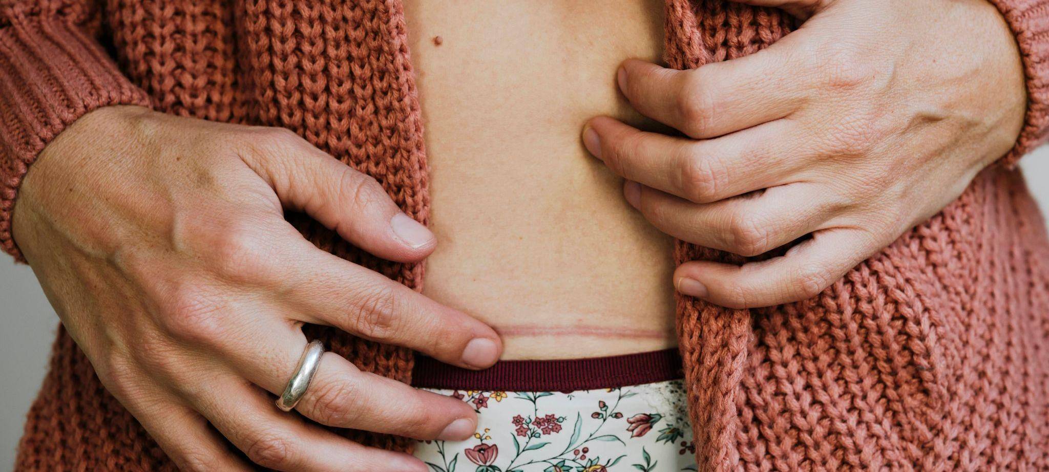 Eine Frau berührt ihre Kaiserschnittnarbe