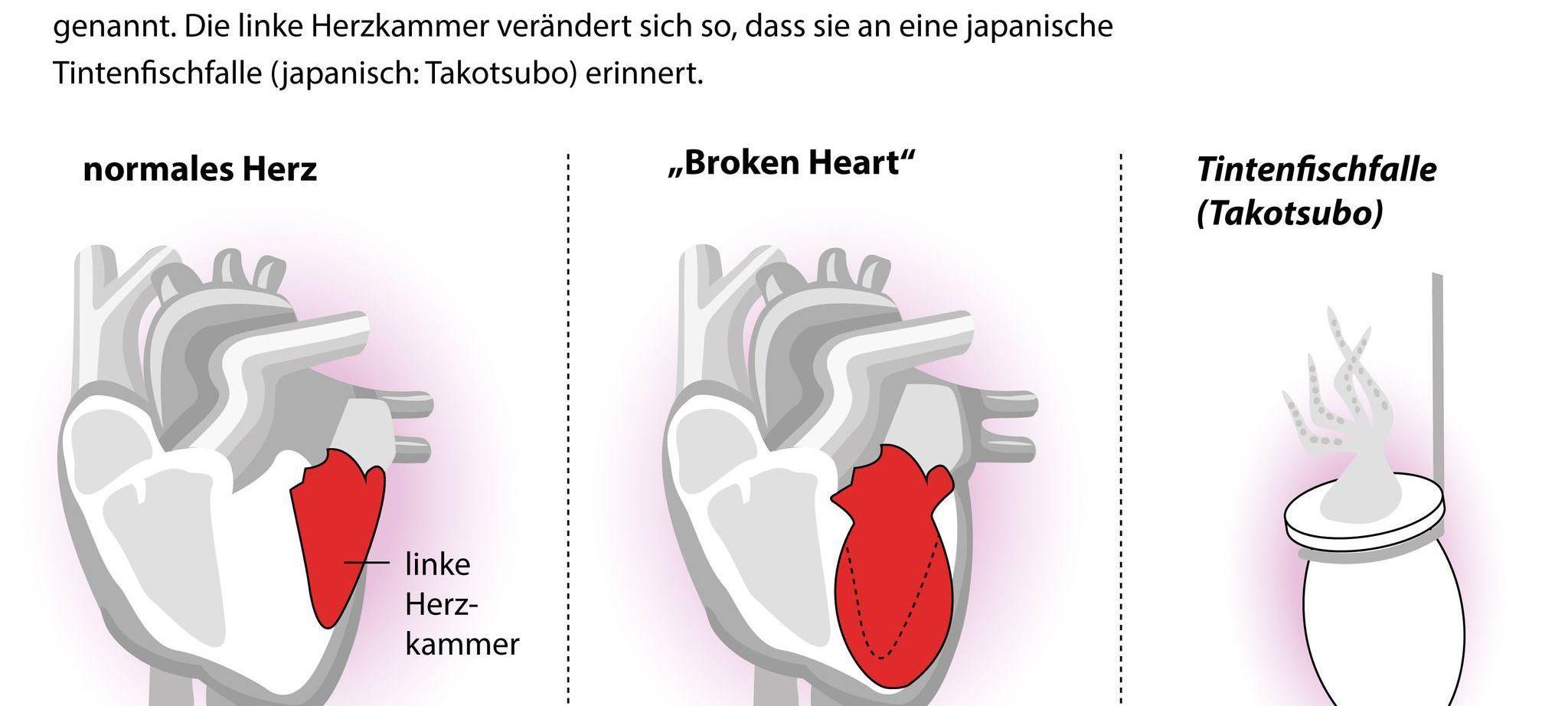Broken-Heart-Syndrom